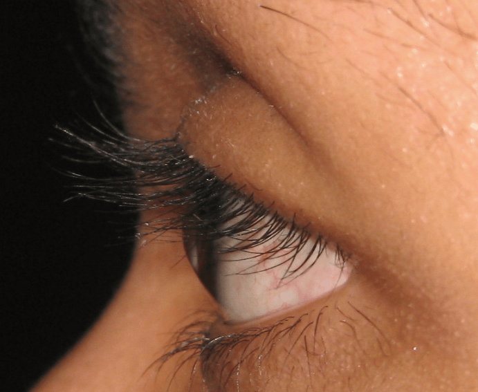 Scleral Contact Lens & Kerasoft IC Fitting Gold Heart Optical Centre