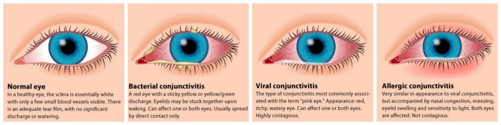 Common Eye Conditions Gold Heart Optical Centre Quezon City