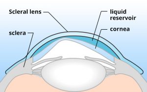 Scleral Contact Lens & Kerasoft IC Fitting | Gold Heart Optical Centre ...