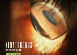 Image of an eye with keratoconus